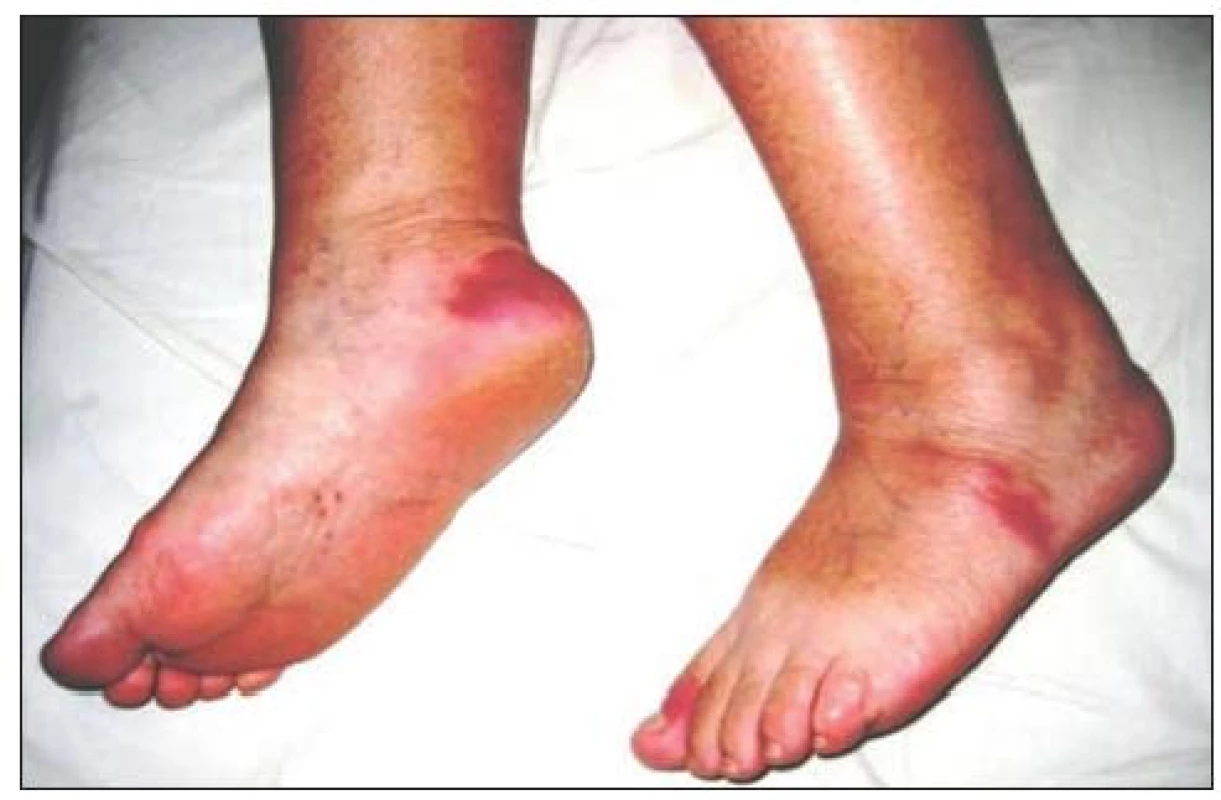 Erythema elevatumm diutinum – extenzorová plocha predkolení