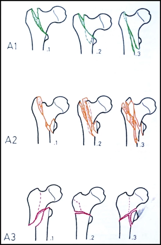 AO klasifikace trochanterických zlomenin A1 – stabilní pertrochanterické zlomeniny; A2 – nestabilní pertrochanterické zlomeniny; A3 – intertrochanterické zlomeniny.
Fig. 4: AO classification of trochanteric fractures A1 – stable pertrochanteric fractures; A2 – unstable pertrochanteric fractures; A3 – intertrochanteric fractures.
