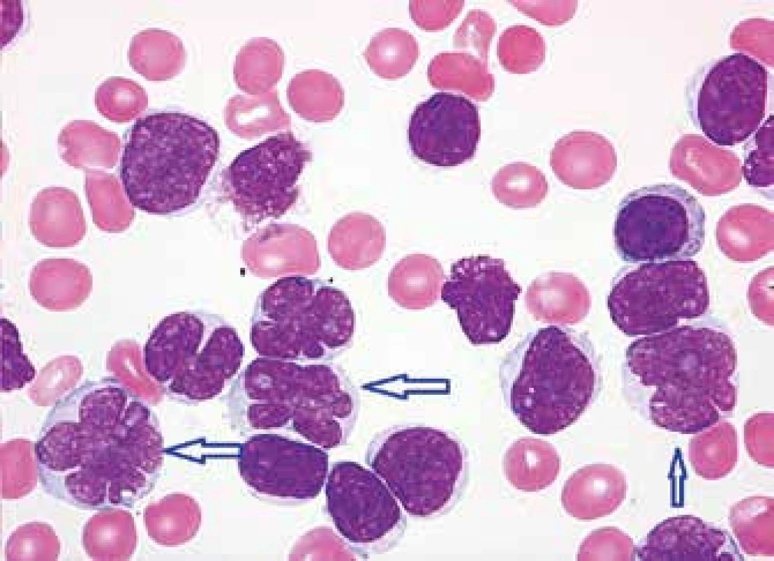 MCL, pleomorfní varianta s prolymfocytoidními rysy (středně velké lymfocyty, některé s bohatší a bazofilnější cytoplazmou, méně kondenzovaným jaderným chromatinem a nukleolem, v popředí jaderné atypie „florálního“ charakteru, prolymfocytoidní elementy označeny šipkami)