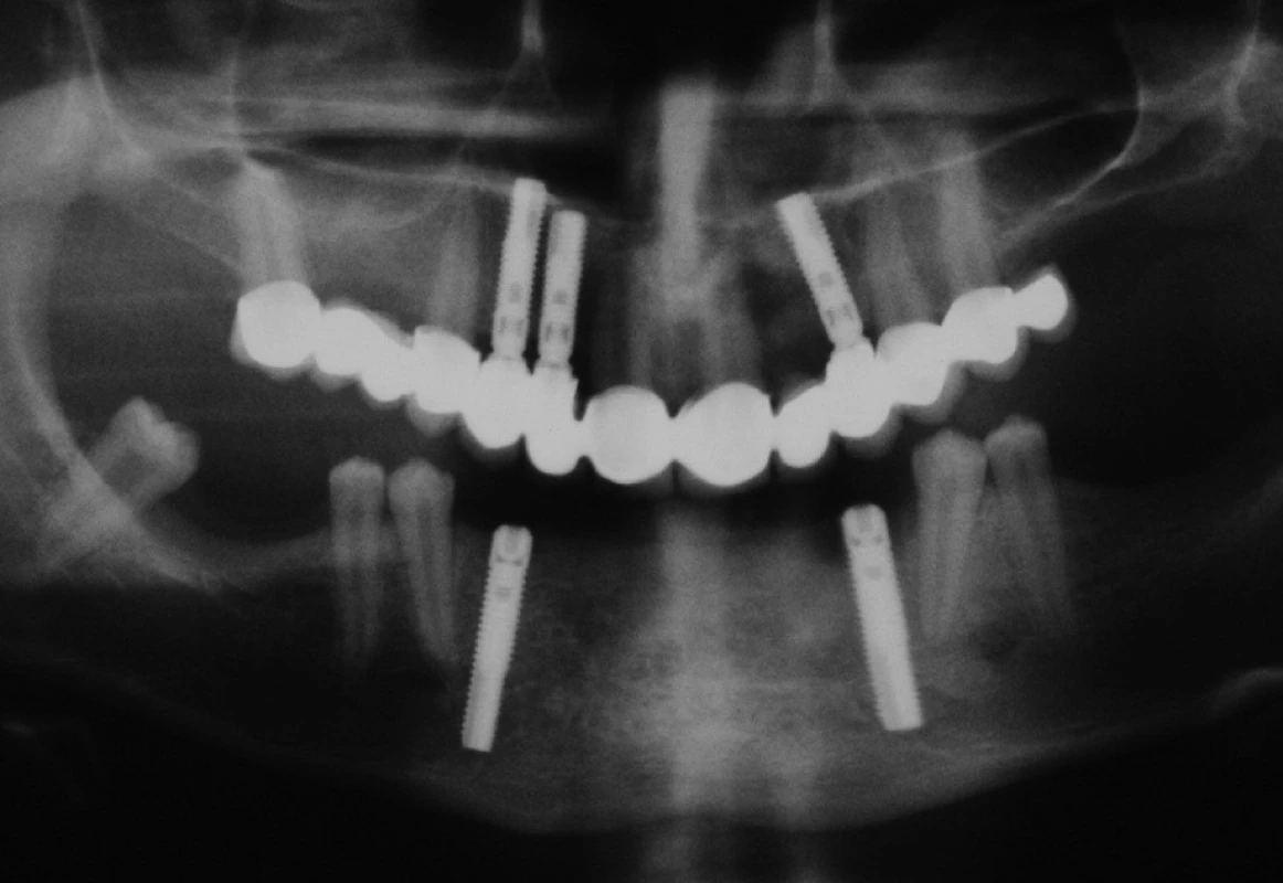 Stav z obrázků 7 a 8 po zhotovení fixní práce v horní čelisti a implantaci v dolní čelisti.