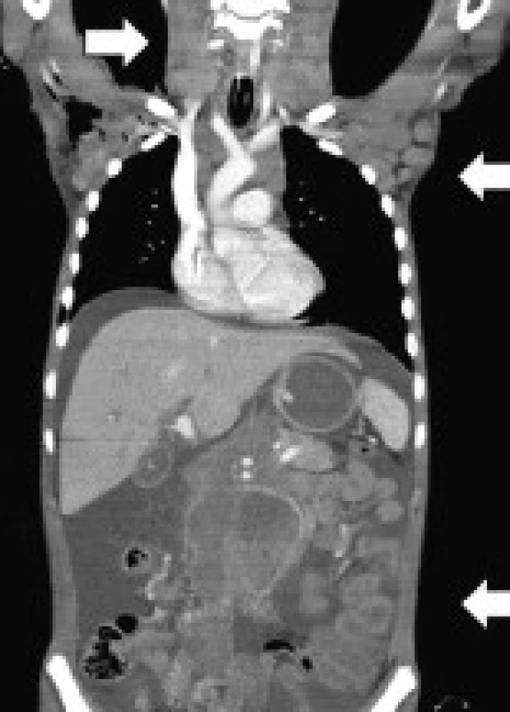 CT snímek při diagnóze Burkitt-like lymfomu u pacienta A1. Na snímku je patrná krční, axilární a abdominální lymfadenopatie a ascites.
Fig. 1. CT imaging in patient A1 with the diagnosis of Burkitt-like lymphoma. The image shows cervical, axillary and abdominal lymphadenopathy and ascites.