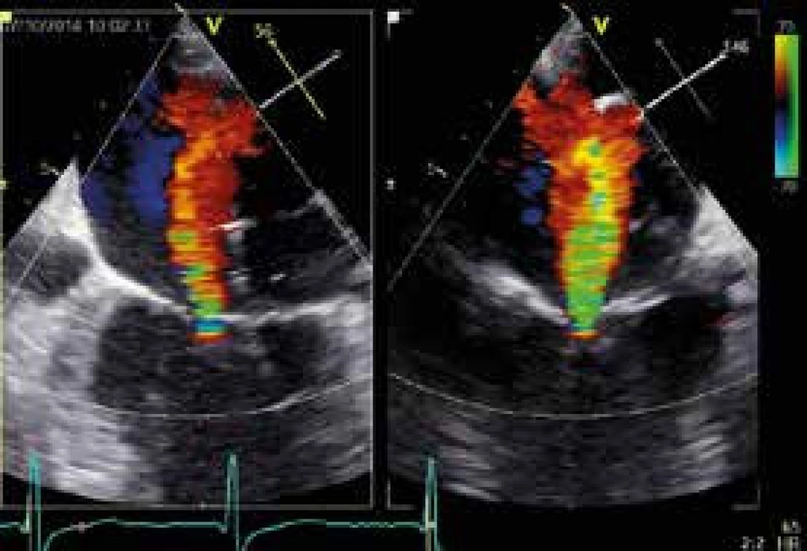 TEE prokazující zmenšení mitrální regurgitace po implantaci prvního MitraClipu, do residuálního jetu je navigován druhý clip (tzv. X-view: intercomissural-2C a LVOT projekce).