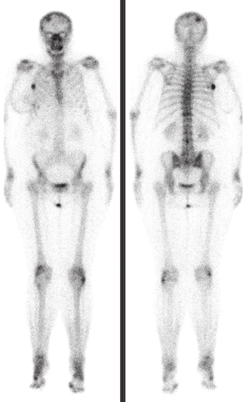 Poslední scintigrafie skeletu provedená po dalších 5 měsících ukazuje výraznou regresi všech ložisek, nově se objevuje ložisko v dolní čelisti vpravo v důsledku její nekrózy. V kontextu těchto vyšetření jsme nález na druhé scintigrafii hodnotili jako flare fenomén. Kostní scintigrafie je velmi citlivá metoda pro detekci kostních abnormalit, zejména metastáz u pacientů se zhoubnými nádory. <sup>1</sup> Je schopná zachytit 10% změnu v obratu kostních minerálů, zatímco skiagrafie vyžaduje pro detekci alespoň 50% demineralizaci. <sup>2</sup> Kostní sken je také schopen detekovat kostní metastázy až o 18 měsíců dříve než skiagrafie. Nevýhodou je, že kostní scintigrafie zobrazuje nespecifickou reakci kostní tkáně na rostoucí metastázu (nikoli metastázu samotnou), interpretace v případě jiných kostních chorob (degenerativních změn, zánětu, Pagetovy choroby nebo úrazu) může být obtížná. Rovněž se může po zahájení protinádorové terapie včetně léčebné aplikace radionuklidů <sup>3</sup> objevit přechodné zhoršení nálezu na kostní scintigrafii nebo zvýšená hladina ALP u pacientů, u nichž je odpověď na léčbu dobrá. <sup>4</sup> Tato situace se nazývá flare fenomén („vzplanutí“ – imituje zhoršení nálezu, ačkoli je způsoben reparací kostní tkáně v místě rostoucí metastázy, která byla účinnou léčbou ovlivněna). Podobný fenomén se však vyskytuje i u scintigrafie (PET) s <sup>18</sup>F-FDG, označuje se termínem metabolický flare. <sup>5,6</sup> Oba tyto fenomény je nutno brát v úvahu při hodnocení léčebné odpovědi podle kritérií RECIST. <sup>7</sup>