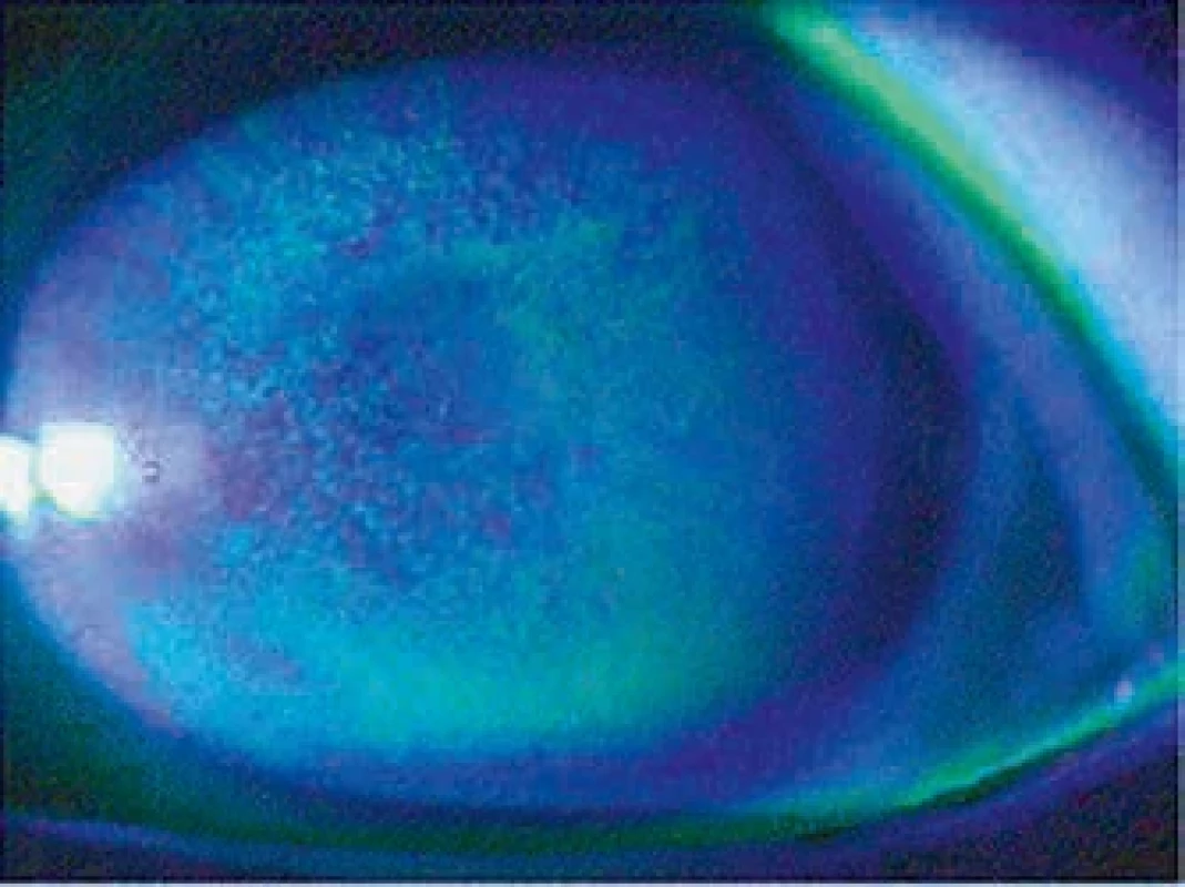 Ophthalmia photoelectrica (po obarvení fluoresceinem v modrém kobaltovém světle). Ophthalmia photoelectrica observed under cobalt blue light after fluorescein staining.