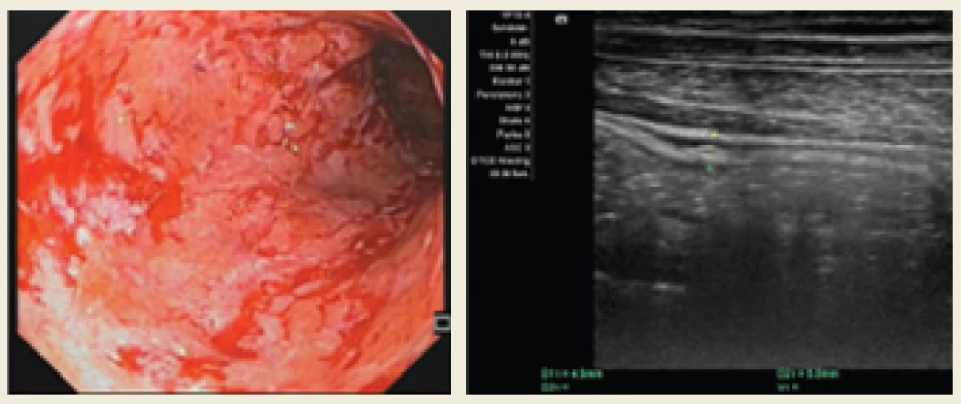 Endoskopický obraz vysoce aktivní UC (eMayo-3) dobře koreloval s aktivitou UC v ultrasonografi ckém zobrazení, které ukázalo hyperechogenní rozšíření stěny tlustého střeva a ztrátu stratifi kace jednotlivých vrstev stěny střevní.