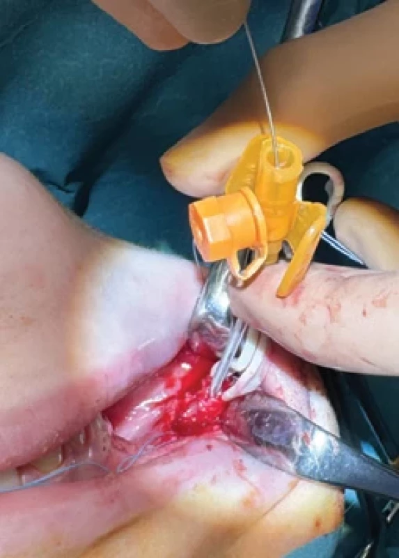 Insertion of a stent – intravenous cannula.