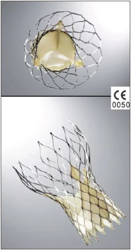 Chlopeň typu CoreValve: v nitinolovém koši je všita vlastní trojcípá biologická chlopeň