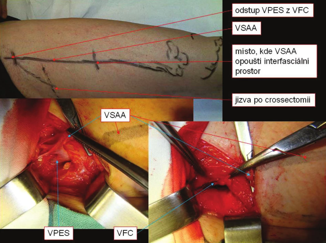 Recidiva varikozit z VPES samostatně ústící do VFC
Fig. 6. Relapses of VPES varicosities, VPES emptying into VFC
