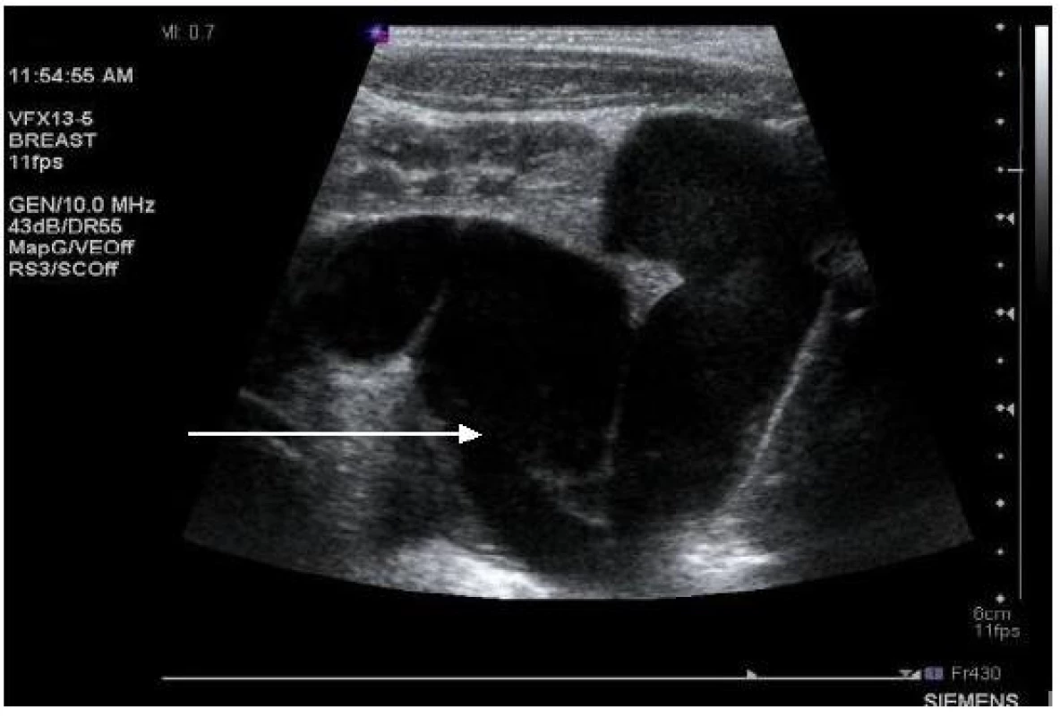 Ultrasonografie, pacient č. 14; šipka ukazuje na výrazně dilatovaný levostranný močovod.

Fig. 4. Ultrasound, patient No 14; gross dilation of the left ureter (arrow).