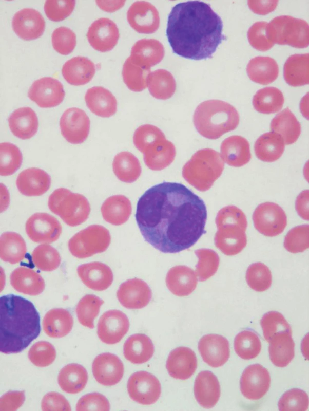 Atypické promyelocyty, schistocyty.