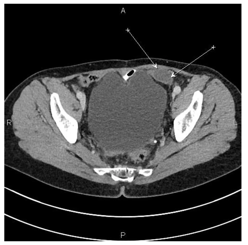 CT nález – šipky označují ložisko na pánevním peritoneu
vlevo<br>
Fig. 1: CT scan – arrows indicate the focus in the left pelvic
peritoneum