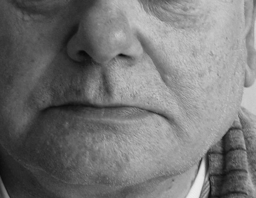 Asymetrie obličeje pomíněná zduřením v oblasti dolního pólu levé příušní žlázy