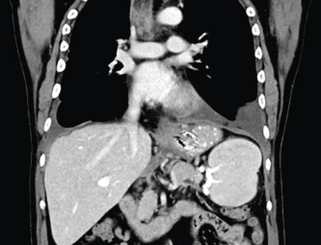 CT snímek hrudníku – pseudocysta mediastina po drenáži – koronární rekonstrukce.