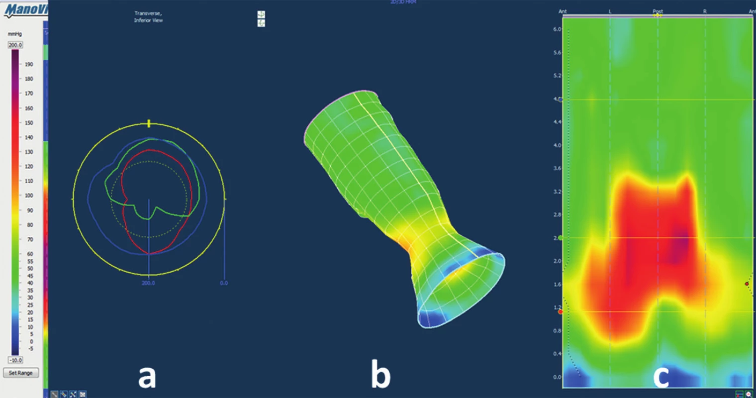 Anorectal pressure morphology during the bear down manoeuvre
