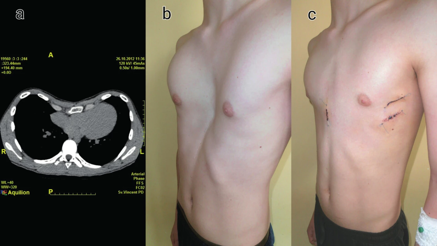 Patient s recidivou pectus excavatum po klasickej korekcii
a) CT nález
b) Lokálny nález pred korekciou
c) Lokálny nález 14 dní po korekcii
Fig. 2: Male patient with recurrent pectus excavatum after open technique
a) CT scan of the deformity
b) Clinical picture before MIRPE
c) Clinical picture 14 days after MIRPE