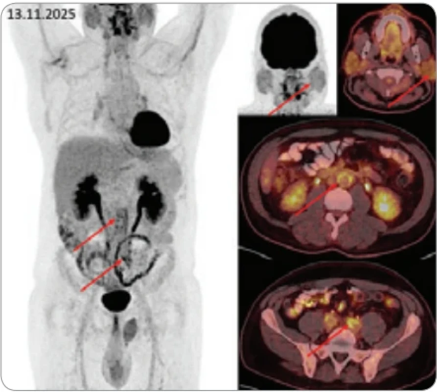 FDG – fluorodeoxyglukóza, IgG4-RD – s imunoglobulinem IgG4 asociovaná choroba, MIP – maximum intensity projection, PET – pozitronová emisní tomografie