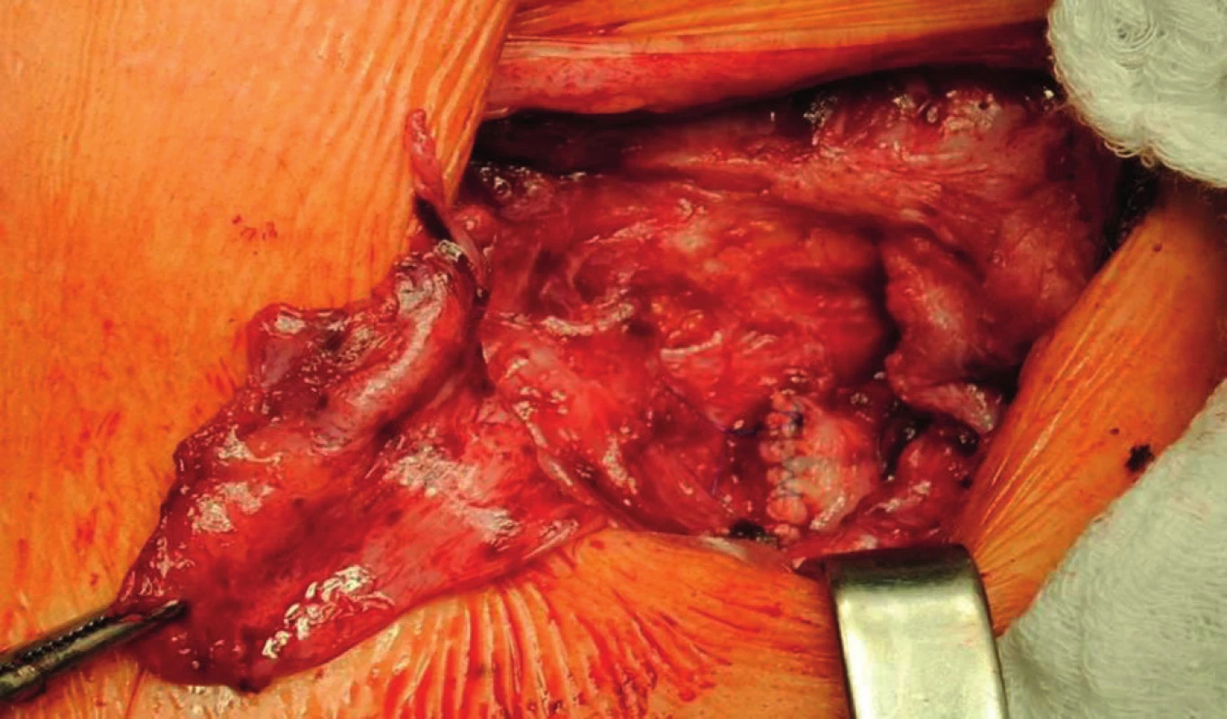 Ligated graft stump left after explantation of the ePTFE graft in the area of proximal anastomosis of the axillofemoral bypass