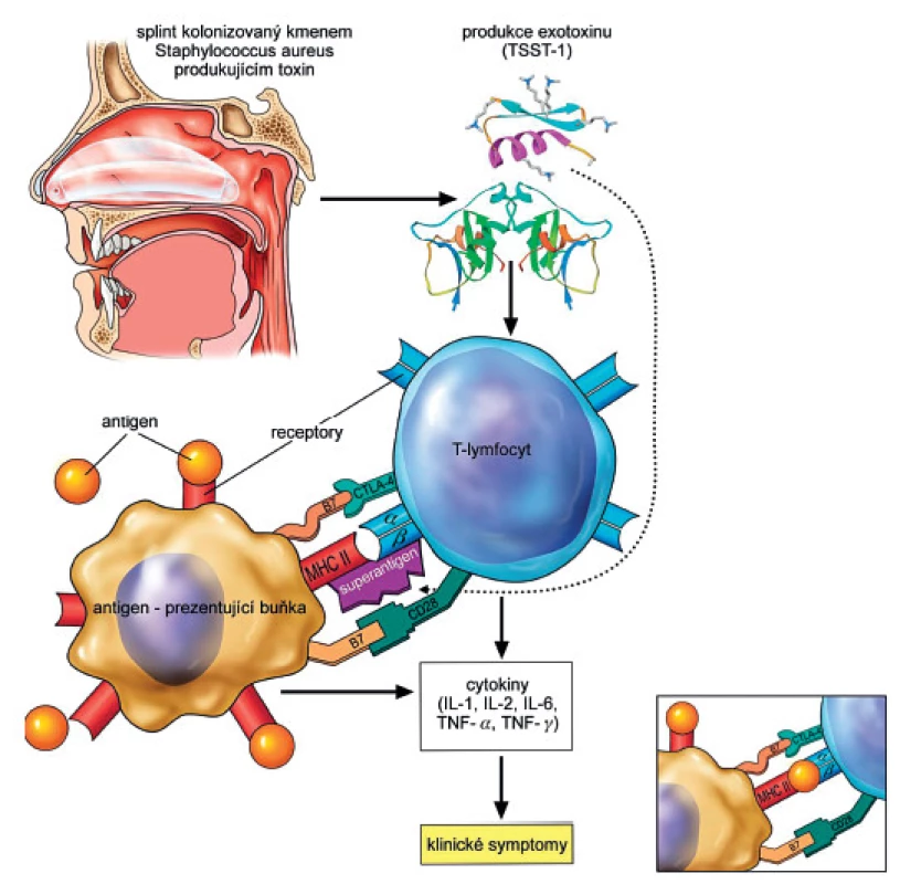 Ve výřezu klasická antigenní stimulace. Zdroj autoři, malíř Jiří Hlaváček.
T-lymfocyt: receptor s α, b podjednotkou; CD28 (cluster of differentiation 28) – koreceptor TSST-1 na povrchu T-lymfocytu; CTLA-4 (cytotoxic T-lymphocyte-associated protein 4)
Antigen prezentující buňka: MHC (major histocompatibility komplex) – molekula hlavního histokompatibilního komplexu II. třídy; B7 (CD80, CD86) protein antigen prezentující buňky
B7 molekuly (CD80 s CD86) na aktivovaných B-buňkách a monocytech/(makrofázích) pracují v tandemu jako ligandy pro dva různé proteiny na povrchu T-buněk (CD 28 a CTLA-4). Po navázání superantigenu a stimulaci imunitní kaskády vazbou B7 na koreceptor CD28 (kostimulace je nezbytná) dochází k proliferaci lymfocytů. (Pozn. CTLA-4 je protein-receptor, který naopak downreguluje imunitní systém, působí jako off-spínač = vysílá inhibiční signál).
Figure 1. Stimulation of T-cells by exotoxin (superantigen)
The small figure picture in the right bottom corner: the classical antigenic stimulation. Source: authors, Jiří Hlaváček, painter.
T-lymphocyte: receptor subunit a, b; CD28 (cluster of differentiation 28) – co-receptor TSST-1 on the surface of a T-lymphocyte; CTLA-4 (cytotoxic T-lymphocyte-associated protein 4).
Antigen presenting cell: MHC (major histocompatibility komplex) – a molecule of MHC class II; B7 (CD80, CD86) a protein of antigen presenting cell.
B7 molecules (CD80 s CD86) on the activated B-cells and monocytes/(macrophages) act in tandem as ligands for the two different types of proteins on the surface of T-cells (CD 28 a CTLA-4). Superantigen binding and stimulation of the immune cascade by binding of receptor B7 to co-receptor CD28 (co-stimulation is essential) lead to the proliferation of lympocytes. (Note: CTLA-4 on its own is a protein – receptor that downrgulates the immune system, it acts as an off switch = sending inhibitory signals.)