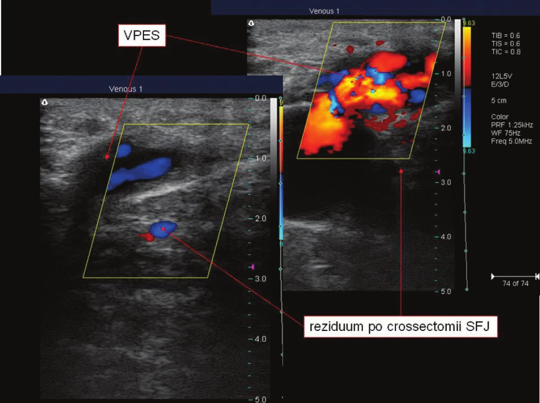 Samostatně ústící VPES do VFC a způsobující recidivu varikozit
Fig. 9. VPES, individually emptying into VFC and causing relapses of varicosities