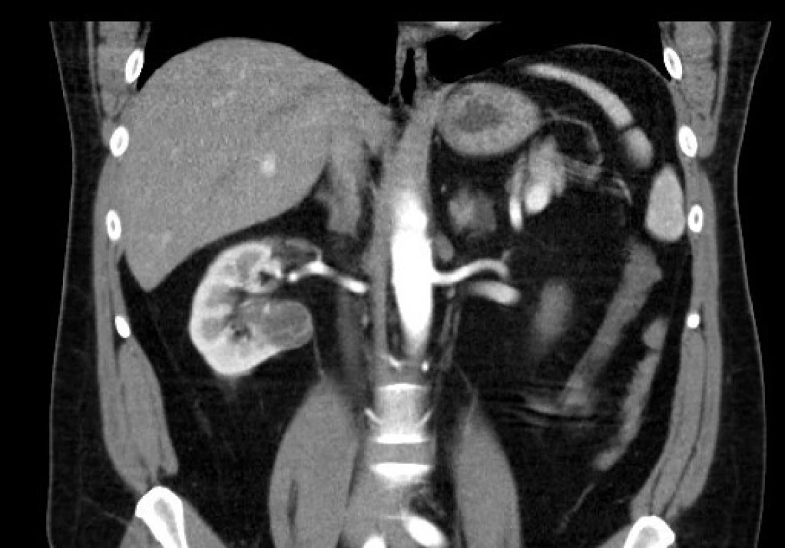 <i>CT zobrazení – Bosniak III</i>
Fig. 6. <i>CT imaging – Bosniak III</i>