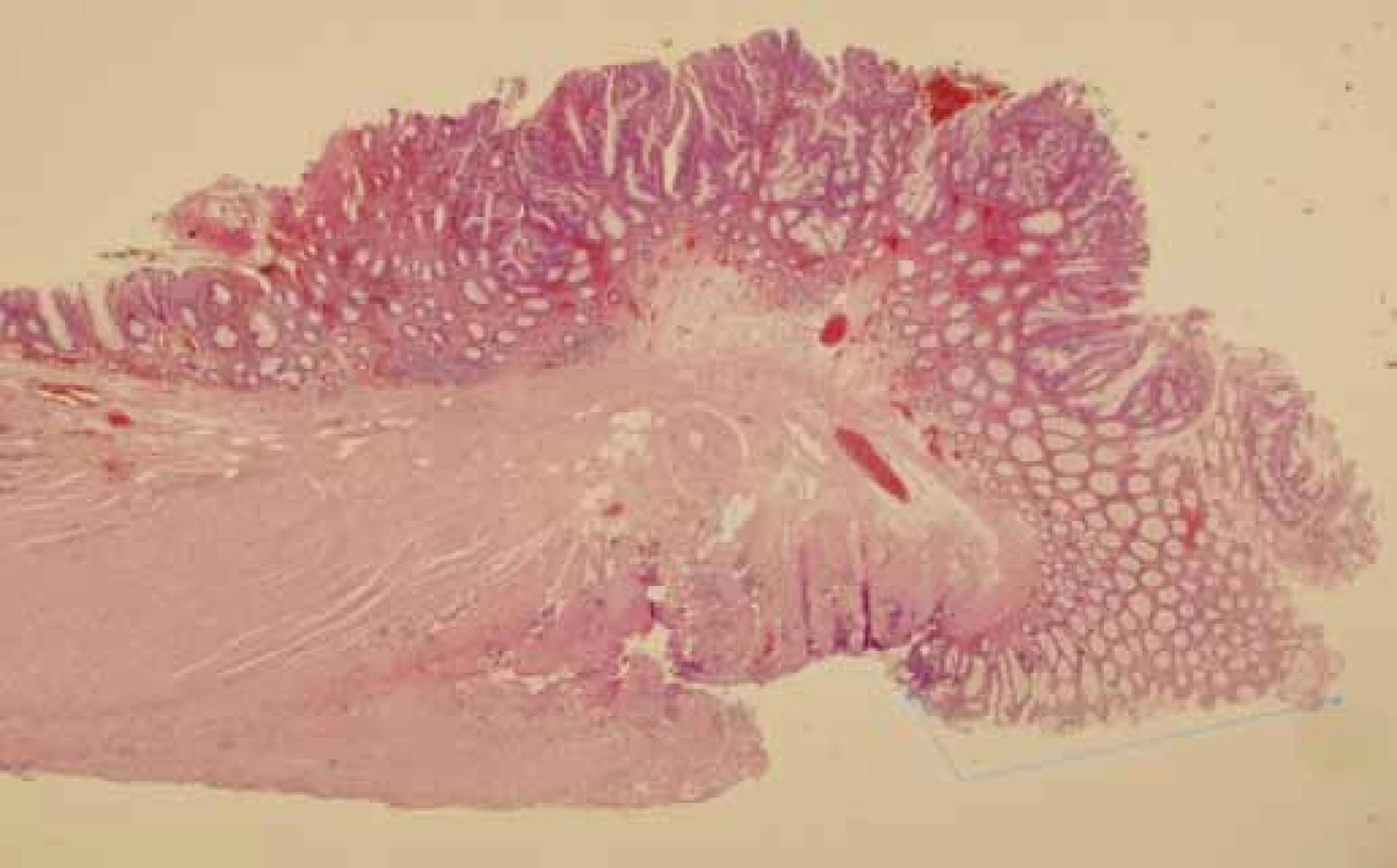 Histologické vyšetření ukazující zdravý lem tkáně v místě nejmenší vzdálenosti léze 
od resekčního okraje.
Fig.8. Histological examination showing a healthy tissue hem in the smallest distance from the lesion resection margins.