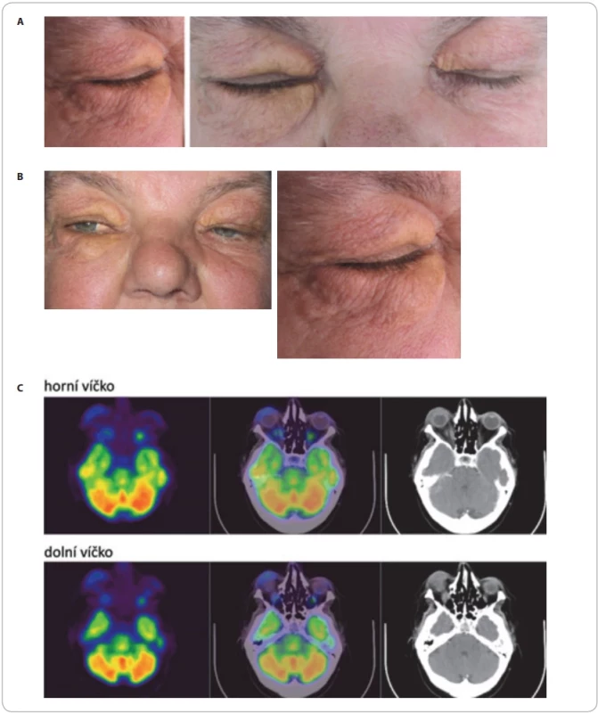 Xantogranulom. (A) Nekrobiotický xantogranulom (tj. xantogranulom a přítomnost M-Ig) víček u pacientky s MGUS typu IgM. (B) Orbitální nekrobiotický xantogranulom, infi ltrující také svaly orbity, bez další diseminace. (C) PET/CT mozku z pacientky s xantogranulomem: transverzální (neboli axiální) řezy PET(v barevné škále Spectrum), PET/CT a CT. Patrná je infi ltrovaná oblast pravého očního víčka (šíře víčka cca 10 mm) s relativně vysokou akumulací FDG (SUVmax 4,87). Méně nápadně i vlevo.