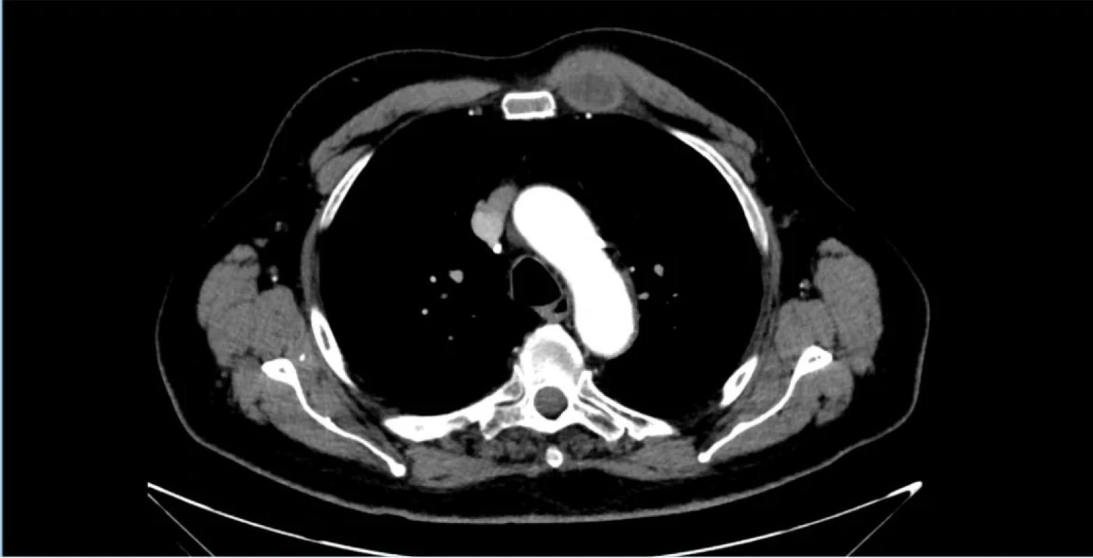 Abscedující ložisko v oblasti pod levým prsním svalem. Zdroj: Archiv Krajské nemocnice Liberec. Fig. 2. Abscess formation in the area deep to the left pectoralis major muscle. Source: Regional Hospital Liberec archive. 