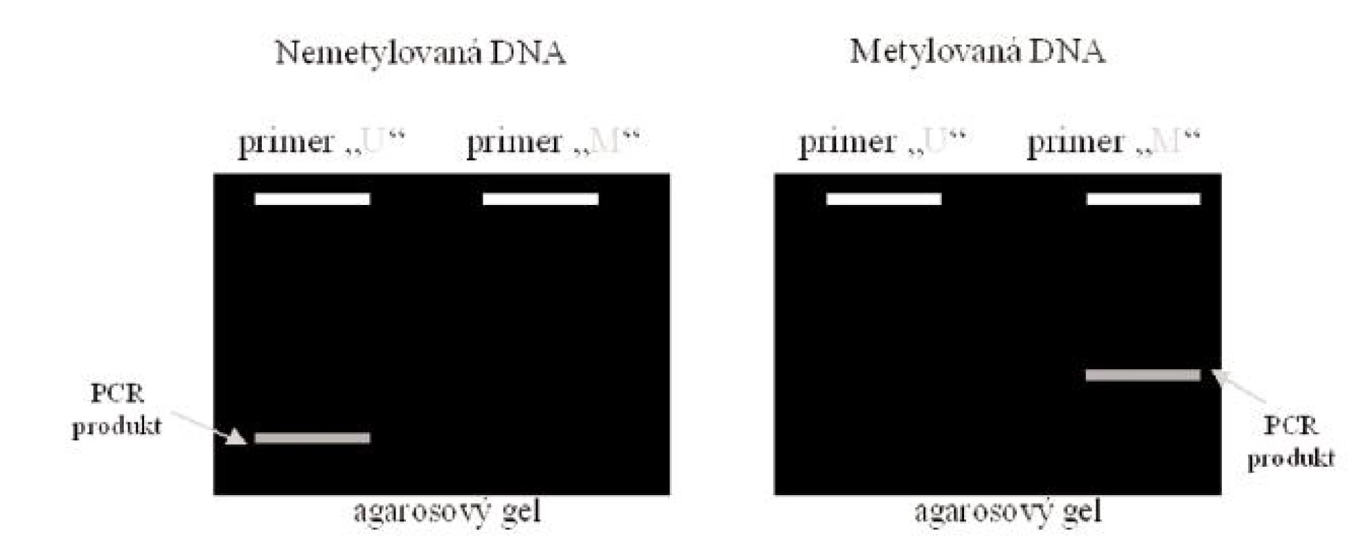 Elektroforetické vyhodnocení MSP
Legenda: Je-li DNA nemetylovaná, vzniká PCR produkt po reakci se setem primerů U, který je specifický pro nemetylovanou DNA. Je-li DNA metylovaná, vzniká PCR produkt po reakci se setem primerů M, který je specifický pro metylovanou DNA.