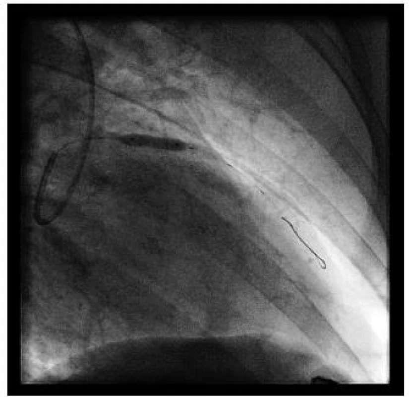 Primární PCI: po rekanalizaci vodičem je do místa uzávěru implantován koronární stent