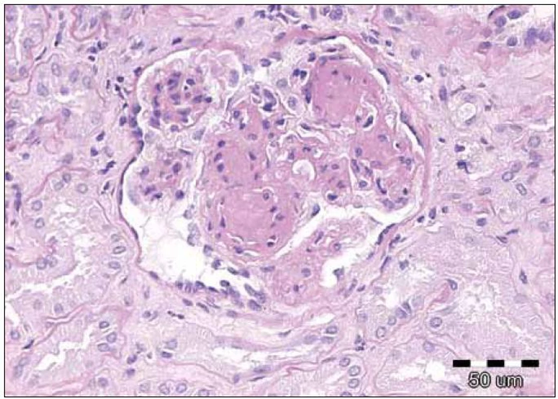 Detail glomerulu s nodulární glomerulosklerózou, která je častým nálezem u nefropatie při depozici lehkých řetězců. Původní zvětšení 200krát, barvení PAS.
