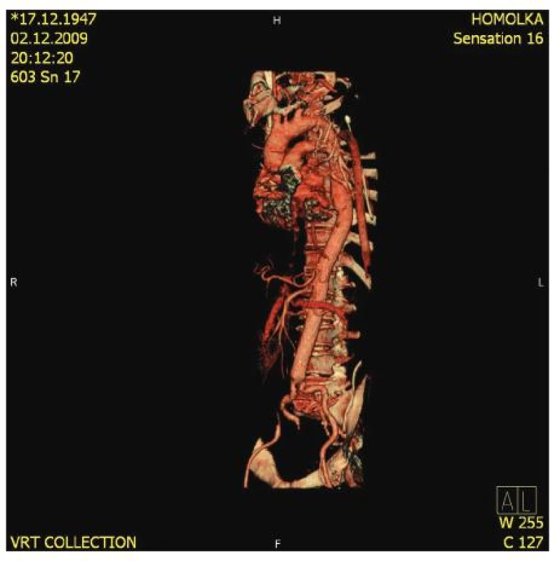 Kontrolní CT-AG po operaci TAAA II. typu
Fig. 9. Control CT-AG following TAAA (type II) surgery