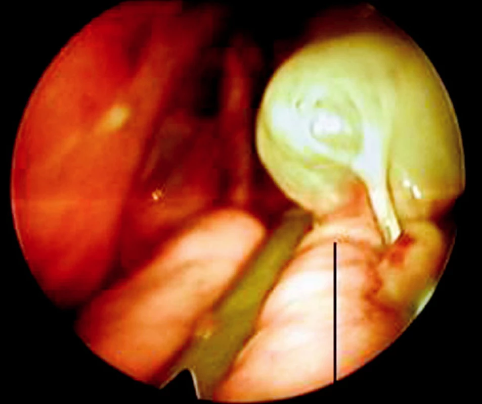 Endoskopická resekce plicní buly
Fig. 2. Endoscopic resection of a pulmonary bule