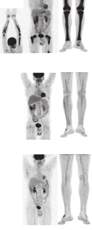 Srovnání akumulace fluorodeoxyglukózy při PET-CT vyšetření před léčbou, v průběhu léčby a 4 roky po ukončení léčby