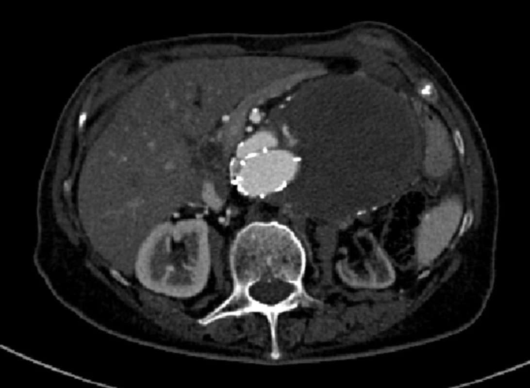 Významná progrese šíře aneuryzmatu, pozdní proximální endoleak I. typu
Fig. 3: A significant progression of the width of the aneurysm, a late proximal type I endoleak