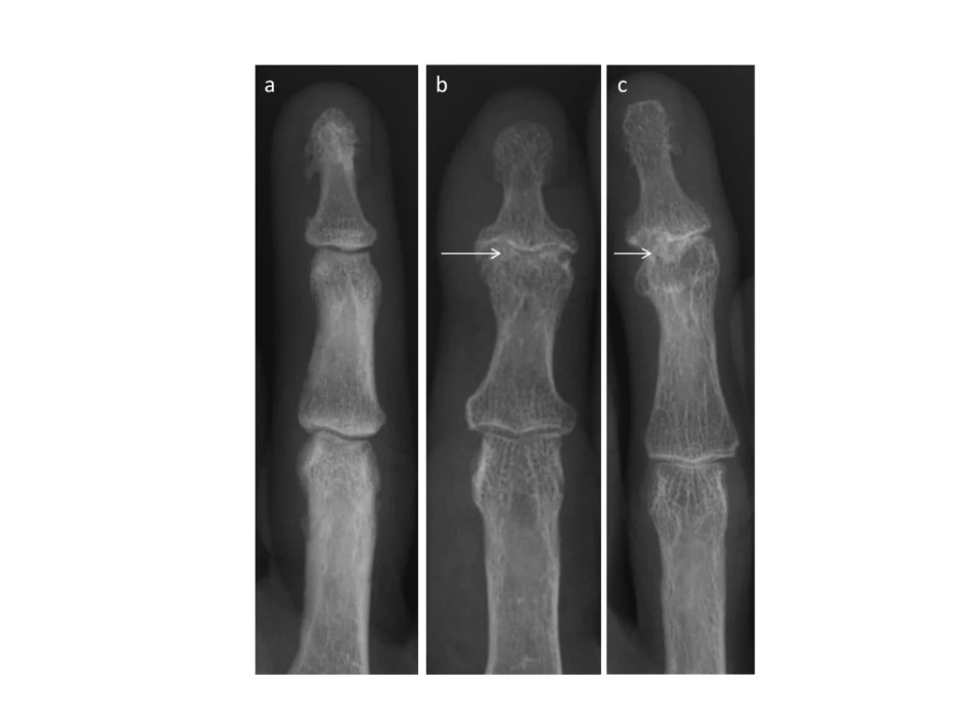 Rentgenové snímky osteoartrózy (OA) ručních kloubů. Počínající Heberdenovy uzly a zúžení kloubní štěrbiny v proximálním interfalangeálním kloubu (a). Erozivní OA postihující distální interfalangeální klouby s charakteristickým projevem centrální eroze (křídla racka) a kolapsem subchondrální kosti (b, c) <em>(z archivu autora).</em>
