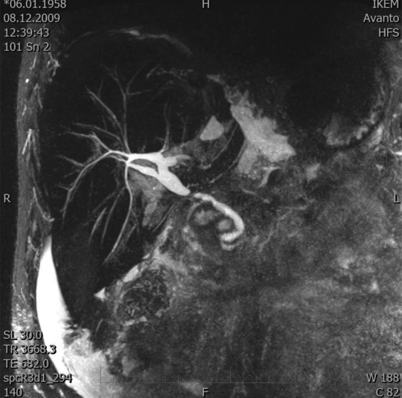 MRCP – stenóza žlučovodu
Fig. 1. MRCP – biliary duct stenosis