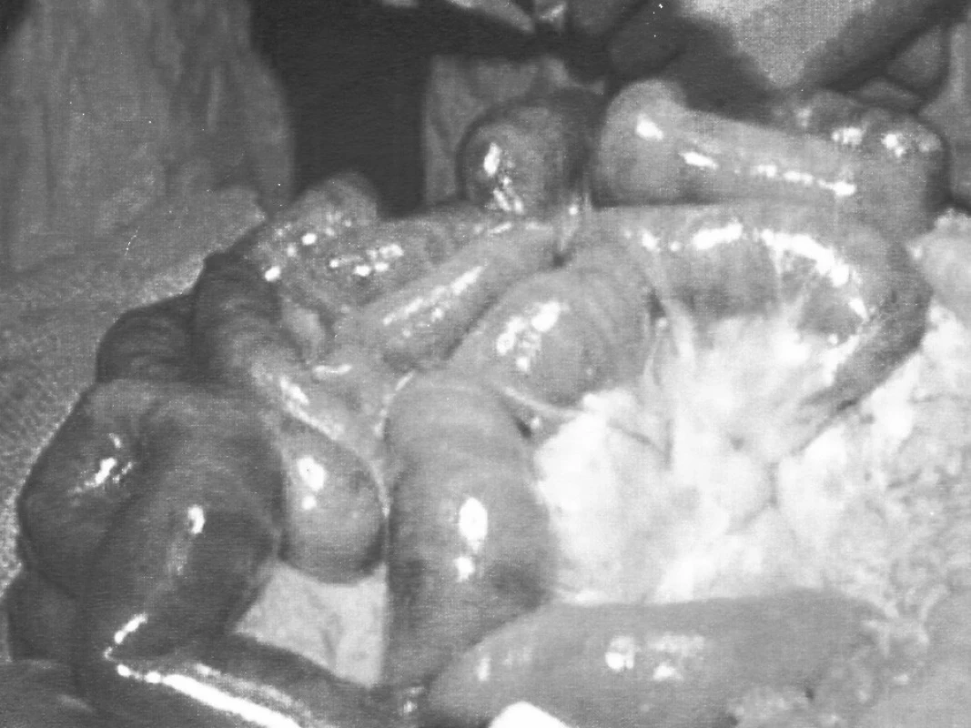 Gangréna tenkého čreva – arteriálny uzáver
Pic. 1. Gangrene of the small intestine – arterial closure