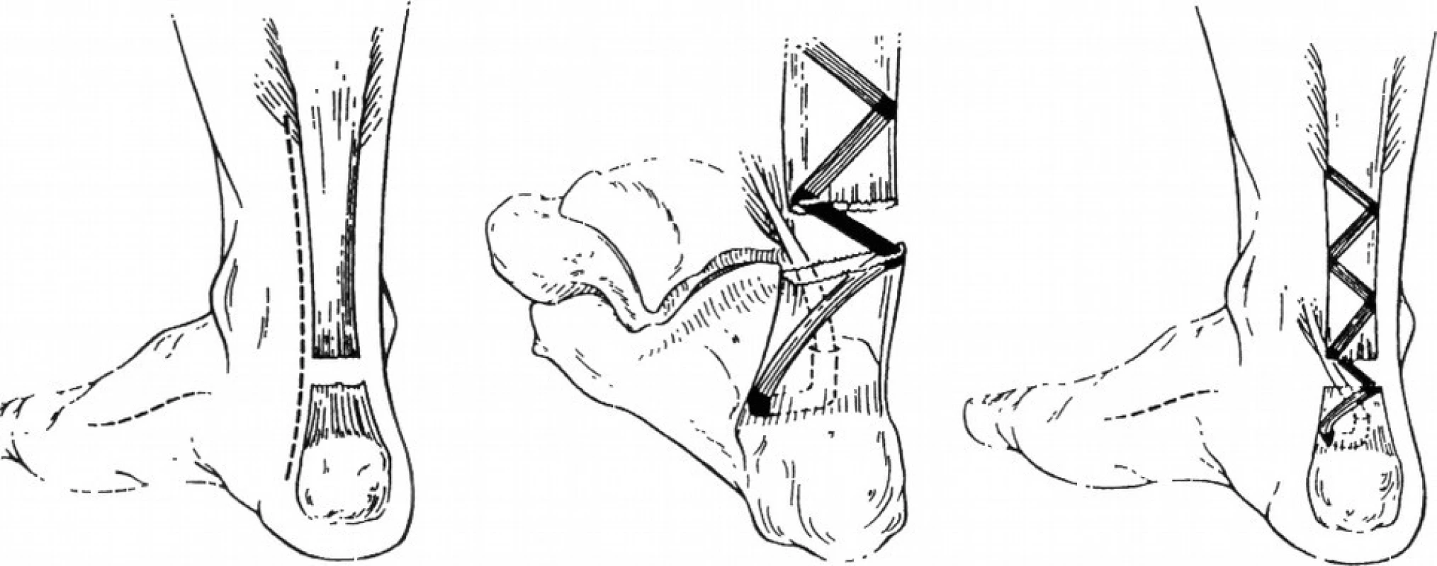 Plastika dle Keith L. Wapnera [15]
(Volně podle Wapner, K.L., Pavlock, G.S., Hecht, P.J., Naselli, F., Walther, R. Repair of chronic Achilles tendon rupture with flexor hallucis longus tendon transfer. Foot Ankle, 14, 443–449, 1993)