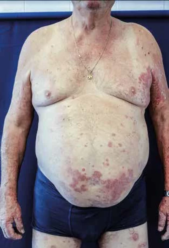 Muž, 65 let, psoriasis vulgaris – před zahájením konvenční terapie. [Foto: archiv autorky]