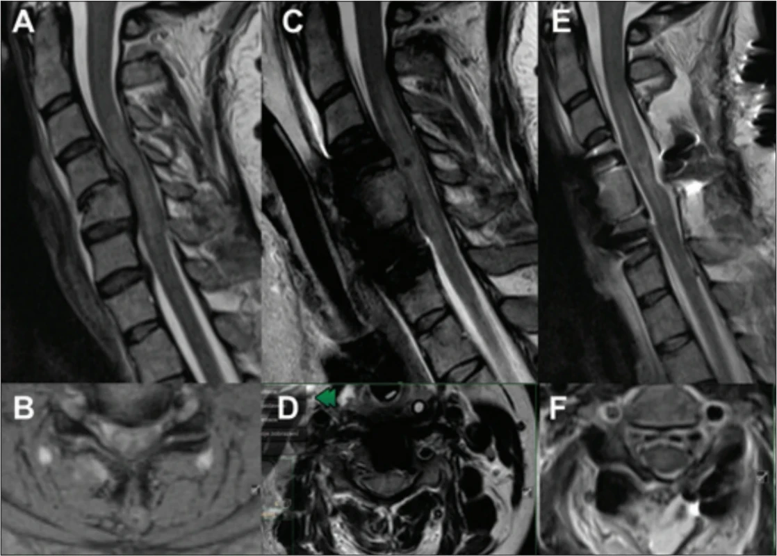 Obraz poranění míchy na MR (sagitální a axiální skeny v T2 váženém obraze).   Fig. 1. MRI image of spinal cord injury (sagittal and axial scans in T2 weighted images).