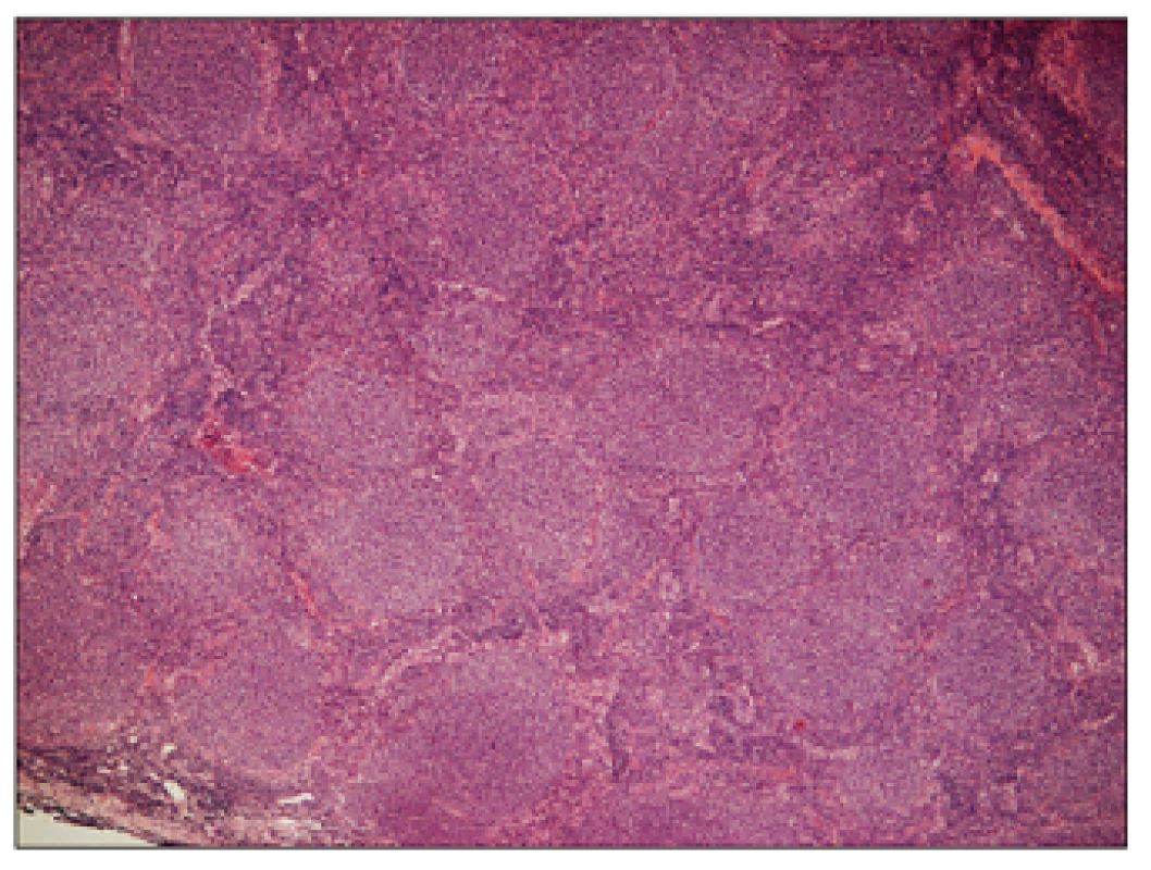 Folikulární lymfom G1, hematoxylin – eosin, zvětšení 50x.
