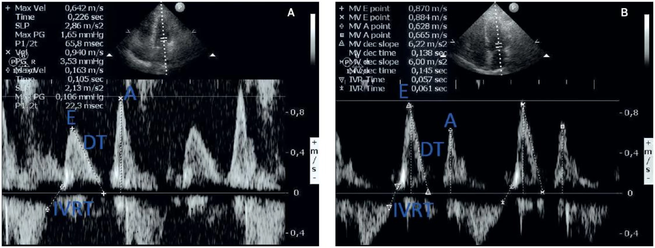 a – echokardiografické zobrazení poruchy diastolického plnění I. stupně (porucha relaxace) a prodloužení izovolumického relaxačního tlaku; b – normální obraz diastolického plnění a IVRT (z archivu autora)