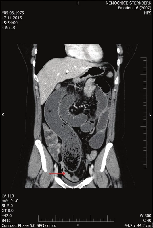 CT dilatované tenké kličky
Fig. 1: CT of the dilated small bowel loop
