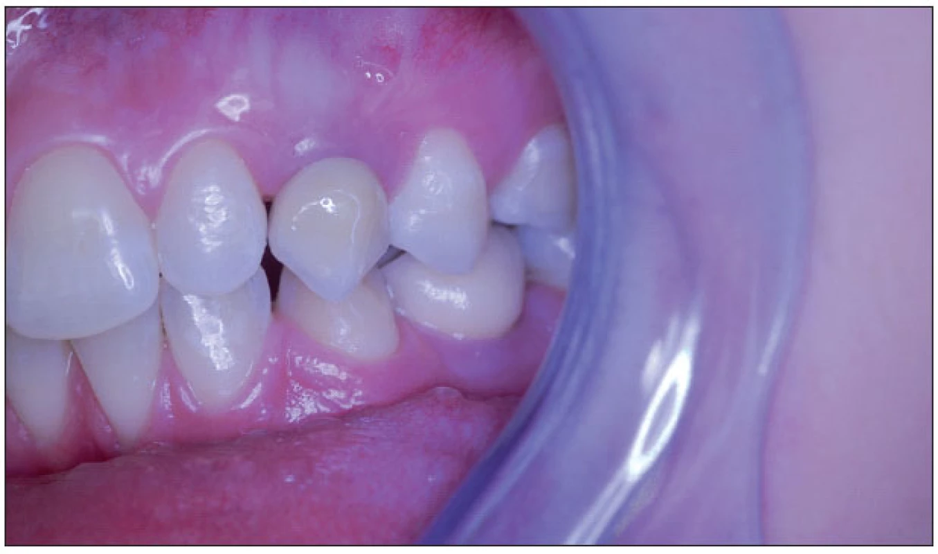 Rekonstrukce levé části zubního oblouku s implantáty 23, 34.