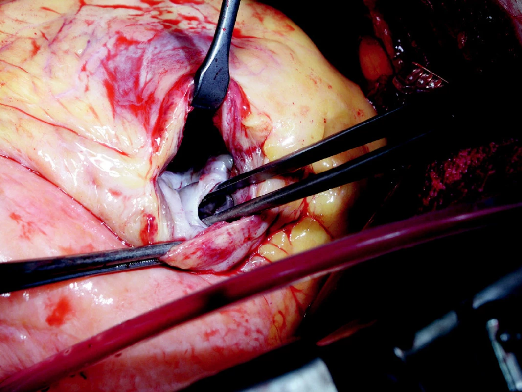 Peroperačný nález defektu hrotovej časti komorového septa
Fig. 1. Intraoperative finding of a defect in the apical part of the ventricular septum 