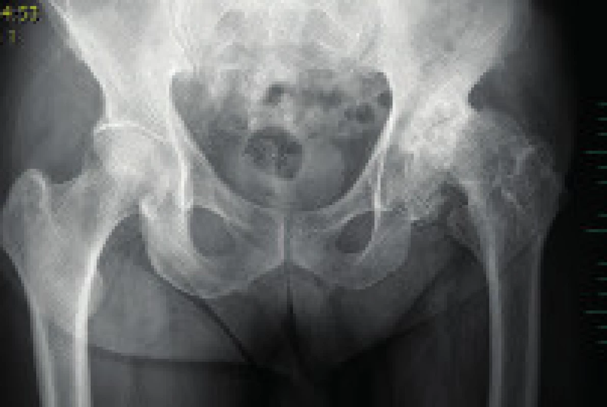 RTG pánve dospělého pacienta se sekundární koxartrózou vlevo po proběhlé Perthesově chorobě v dětství.
Fig. 7. Pelvis X-ray of an adult with secondary hip osteoarthritis of the left hip joint as a result of Perthes disease in childhood.