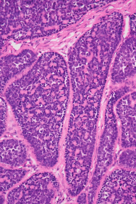 Nádor hematoxylin eosin, zvětšení 400x.