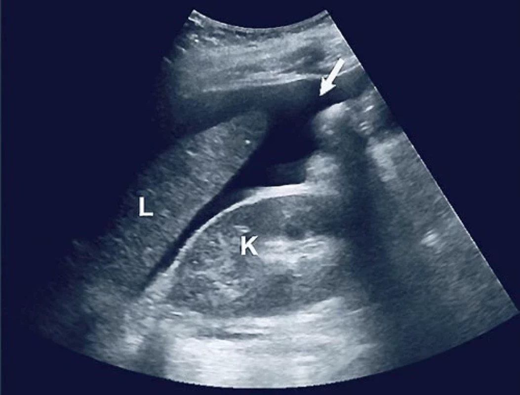 Bed side ultrazvukové vyšetření v režimu FAST (focused assessment with sonography for trauma) – hypoechogenní ložisko v oblasti jater.