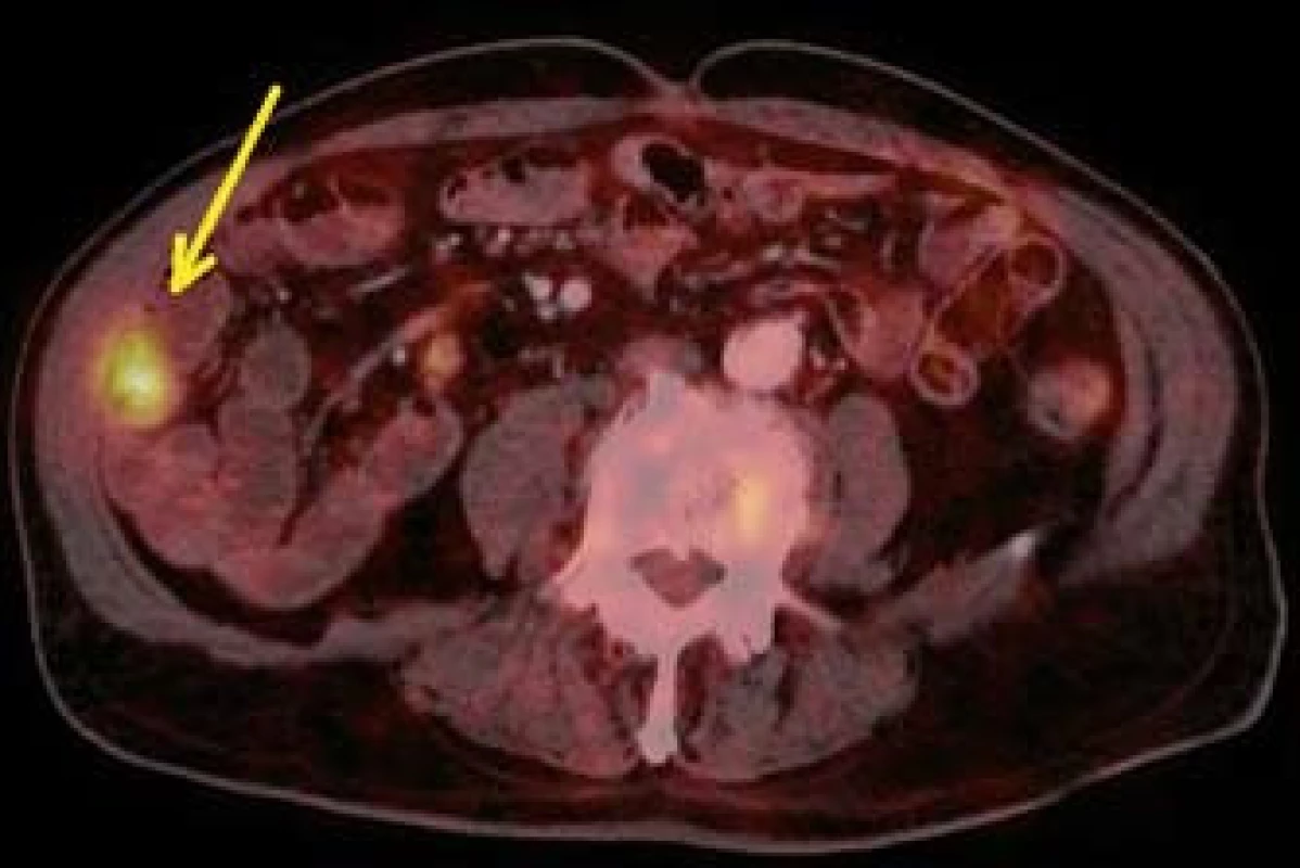 PET CT – metastáza v oblasti kliček tenkého střeva (šipka).
Fig. 9. PET CT – small bowell metastasis (arrow).