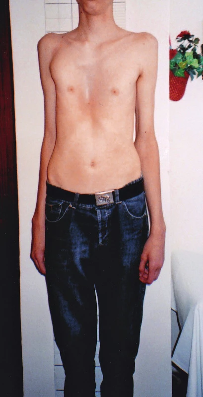 Dlhé, úzke končatiny, deformita hrudníka.
Fig. 1. Long, slender limbs, chest deformity.